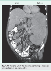 Splenomegaly (enlargement spleen) 
