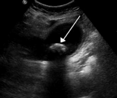 What does this ultrasound show?