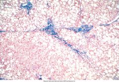 Can you guess what is wrong with this liver tissue?