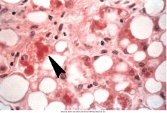 This is a slide of liver tissue.  Name the condition.