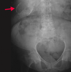 When would you see a "porcelain" gallbladder?