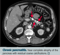 - Chronic inflammation
- Atrophy
- Calcification of pancreas (image)