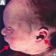 - Low-set ears
- Retrognathia (posterior positioning of mandible)