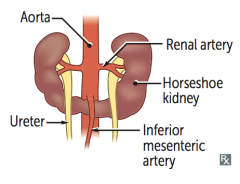 Inferior poles of both kidneys fuse
- As the kidneys ascend from the pelvis during fetal development, horseshoe kidneys get trapped under the inferior mesenteric artery
- Remain low in abdomen