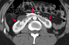 What does this axial CT of abdomen with contrast show?