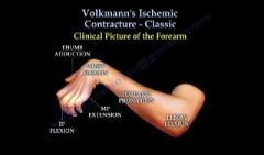 ischemia of the flexor muscles of the forearm causing a Volkmann's ischemic contracture of the involved muscles