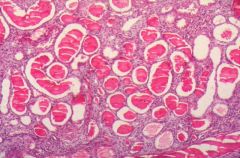 What pathology is seen here?
 
What is this pathology pathoneumonic for?