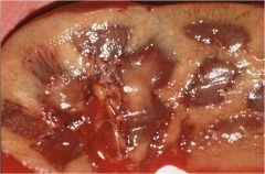 What pathologic features can be seen here?


 


What is the most likely diagnosis?