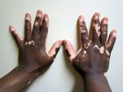 localized loss of skin pigmentation characterized by milk-white patches


 


 