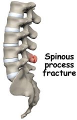 Spinous process fracture