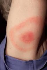 1. stage 1 - early, localized infection. a) erythema migrans is the hallmark skin lesion at site of the tick bite. Characteristically it is a large, painless, well-demarcated target-shaped lesion, commonly seen on the thigh, groin or axilla
2. St...