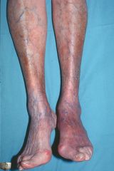 Late, persistent infection (months to years after initial infection)
a. arthritis - this occurs in 60% of untreated patients. It typically affects the large joints (especially the knees). Chronic arthritis will develop in some patients)
b. Chron...