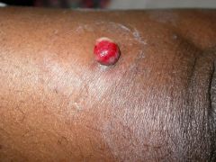  


 


Most common cause of bright red, firm, friable nodules in an HIV patient?