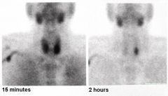 Sestamibi scan (using technetium-99m)
- The Tc99 is initially taken up by BOTH thyroid and parathyroid glands.  The thyroid uptake is, over time, washed out, yet sestamibi is retained by adenomatous parathyroid glands. 

(imagine showing L ante...