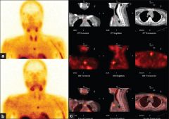 Sestamibi sensitivity in the literature is 70-100%. 

Single proton emission computerized tomography (SPECT) scanning for primary hyperparathyroidism increases the accurace of routine sestamibi scanning by about 2-3% by providing a three-dimensi...