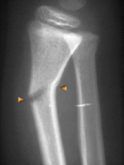 Torus following axial compression due to viscoelasticity of the bone

Greenstick (displayed)