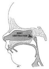 • Congenital bony or membranous septum between nose & pharynx