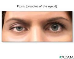 • Drooping of upper eyelid

• May involve CN 3, 5, and/or 7