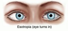 • Form of strabismus

• Eyes turn inward