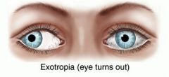 • Form of strabismus

• Eyes turn outward