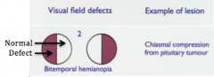 • Bitemporal hemianopsia