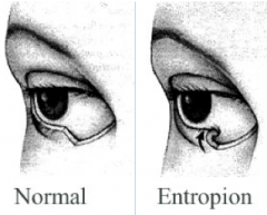 • Inward turn of eyelid

• Lashes irritate conjunctiva

• Occurs with weak muscles & commonly normal aging