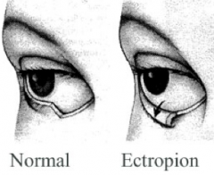 • Outward turn of eyelid

• Most prominent on medial side

• Causes increased tearing, loss of tears, and dry eyes

• Occurs with muscle loss

• Common with normal aging

• Can cause conjunctivitis due to to exposure of palpebral conjunctiva