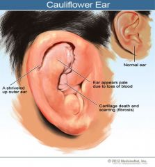 • Abnormal shape of the ear

• Due to repeated rauma to underlying cartilage