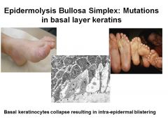 The collapse of basal keratinocytes