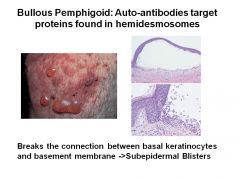 •	Auto-antibodies target proteins found in hemidesmosomes. 
•	Breaks the connection between basal keratinocytes and basement membrane -> subepidermal blisters
