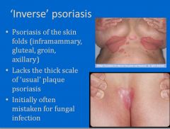 Happens in skin folds; doesn’t have the usual scales of psoriasis