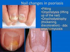 •	Pitting
•	Onycholysis (lifting up of the nail)
•	Onychodystrophy (thickening, discoloration)