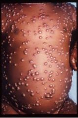 Can you describe the genome of the virus that causes this characteristic pustular rash?