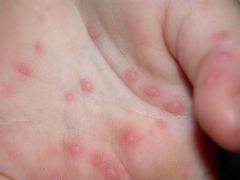What virus(es) cause hand, foot, and mouth disease?
