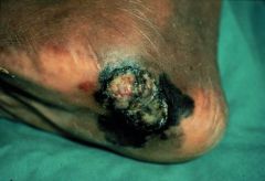 Africans and Asians get melanomas on palms and soles