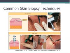 •	The two most common methods of skin biopsy are a shave biopsy or punch biopsy.  
•	. Many methods of skin biopsy are available for sampling skin tissue. These include: shave, punch, curettage, incisional or excisional biopsies.