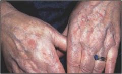 •	Actinic Keratoses
•	Must be treated, because 1-5% can progress to squamous cell carcinoma. 
•	Treatment: cryotherapy with liquid N2, topical medications, photodynamic therapy