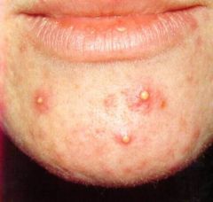 A pustule is a pus-filled papule ( raised lesion of the skin < 1 cm)