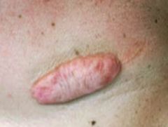 A keloid is a fibrotic (scarring process) that extends beyond the borders of the original defect.
