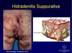 What are the top risk factors for hirdadrenitis supparativa?