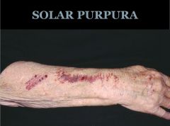 Solar purpura is a chronic sun-induced degradation of collagen around blood vessels leading to easy fragility of the blood vessels to external trauma (as simple as someone scratching)