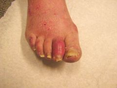 “Sausage finger/toe” occurs in psoariatic arthritis