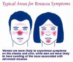 Rosacea is a chronic inflammatory disorder affecting the blood vessels and pilosebaceous units of the face. It’s characterized by increased reactivity, instability of capillaries leading to flushing, blushing, and telangiectases.