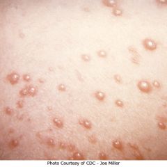 What viral infection has a skin manifestation described as “dew drops on a rose petal (vesicular rash)?”