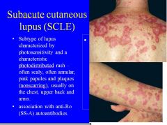 Subacute cutaneous lupus (SCLE)