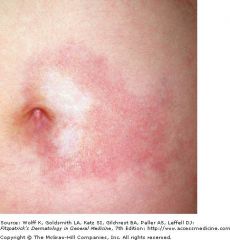 Morphea is a skin-only form of scleroderma, aka. “localized scleroderma.”