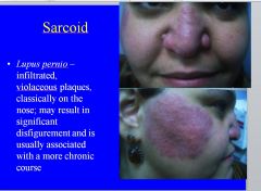 Lupus pernio is a skin manifestation of sarcoidosis. It’s characterized by infiltrated, violaceous plaques classically on the nose.