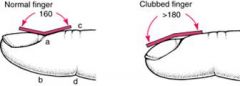 Clubbing refers to the soft tissue swelling around the terminal distal phalanx – the loss of the normal angle between the nail and the nail bed.