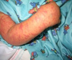 The rash in sJIA is an evanescent, maculopapular, salmon pink rash