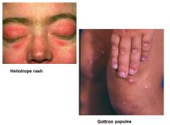 Look for Gottron papules and heliotrope rash in juvenile dermatomyositis (JDM)